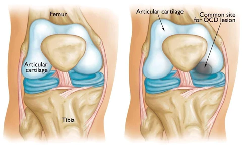 Osteochondritis Dissecans